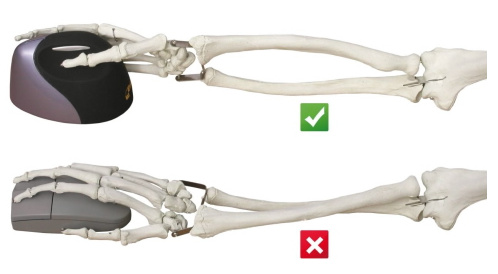 Předejděte syndromu karpálního tunelu s ergonomickou myší 1 Vertikální myš